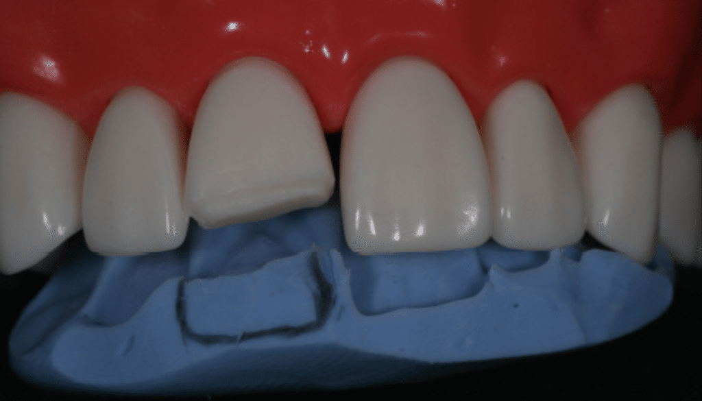 clé palatine silicone composite antérieur