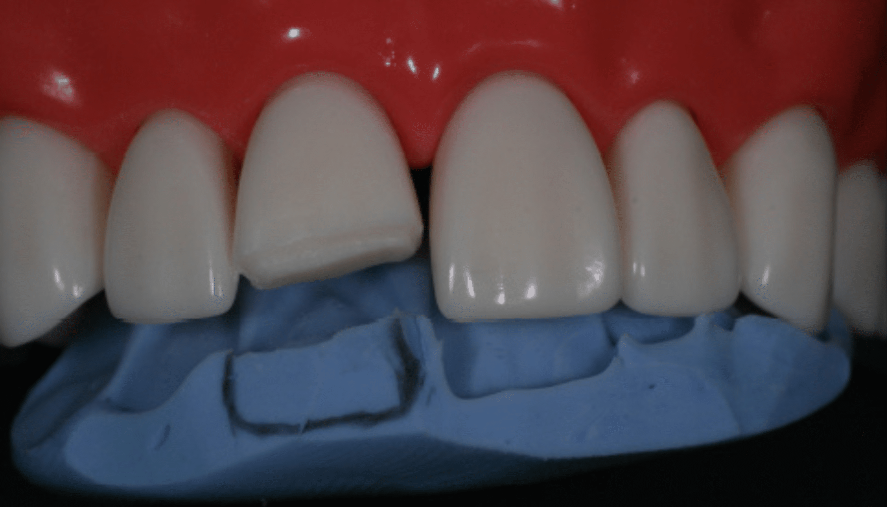 clé palatine silicone composite antérieur