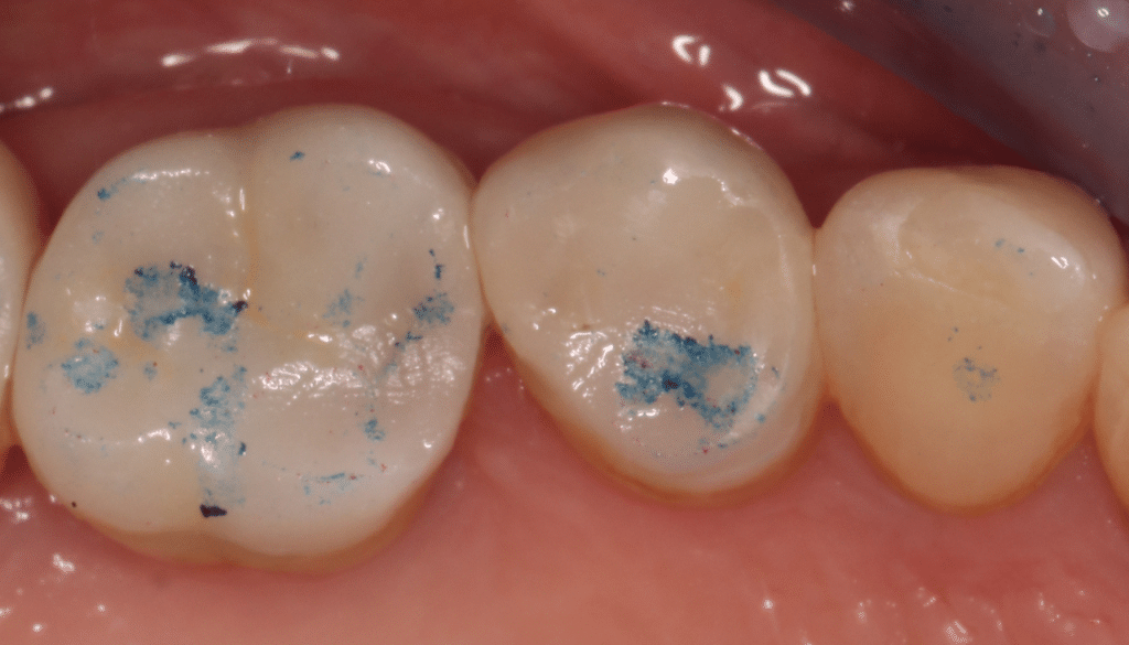 Marquage occlusion dentaire