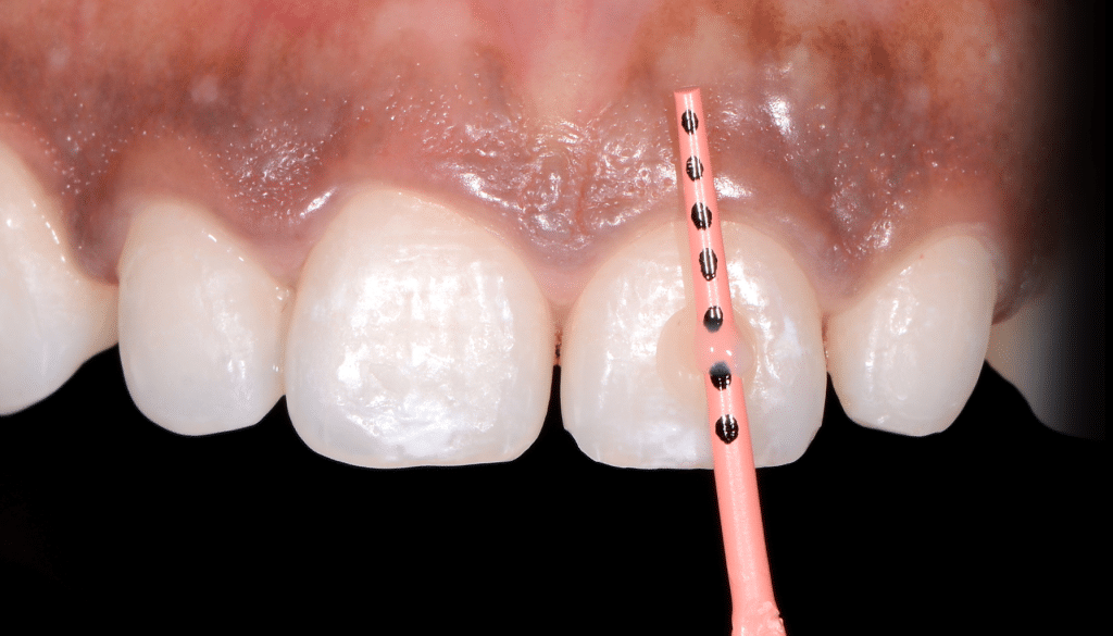 Gingivoplastie