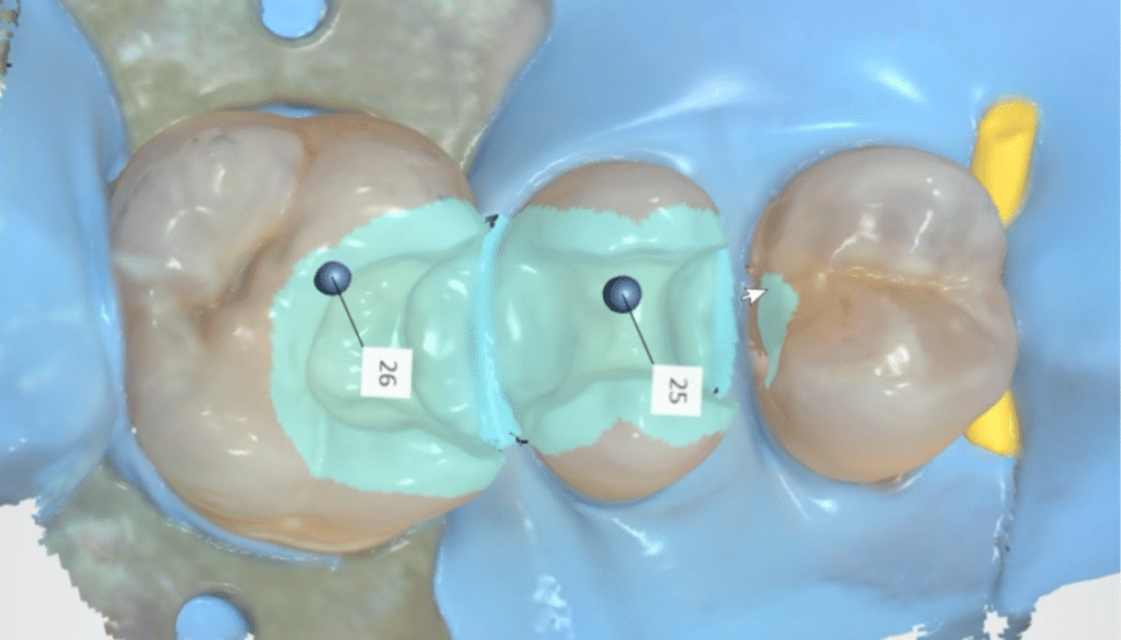 CFAO Inlays