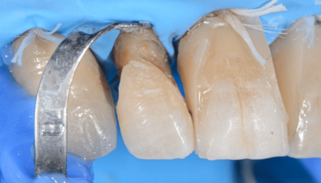 Prise en charge caries profondes