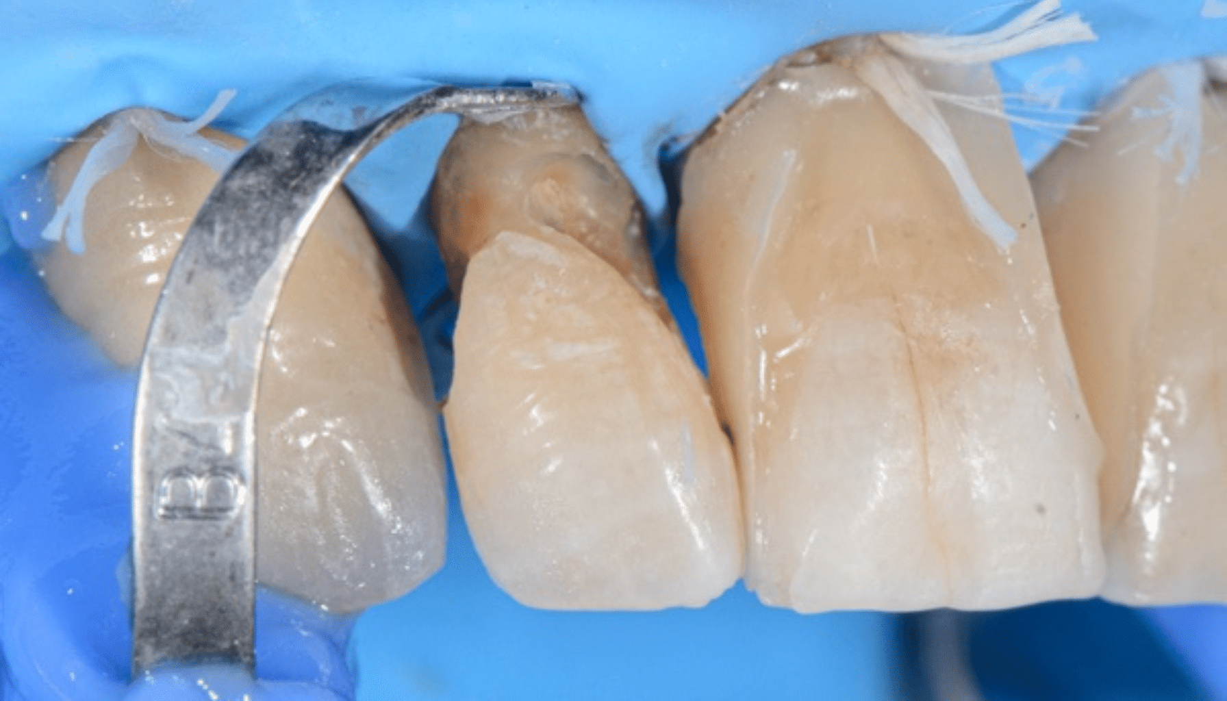 Prise en charge caries profondes