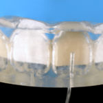 formation dentaire composites injectés academie du sourire