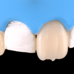 formation dentaire composites injectés academie du sourire