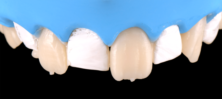 formation dentaire composites injectés academie du sourire