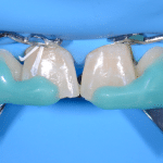 formation dentaire cantilevers collés masterclass