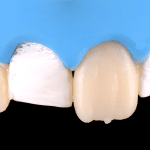 formation composites injectés dentaire dentiste composites injectés masterclass