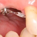 formation dentaire minivis orthodontiques academie du sourire