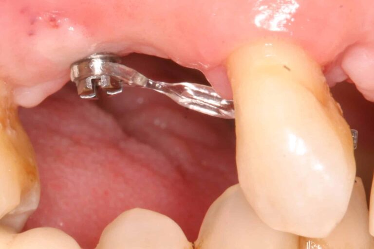 formation dentaire minivis orthodontiques academie du sourire