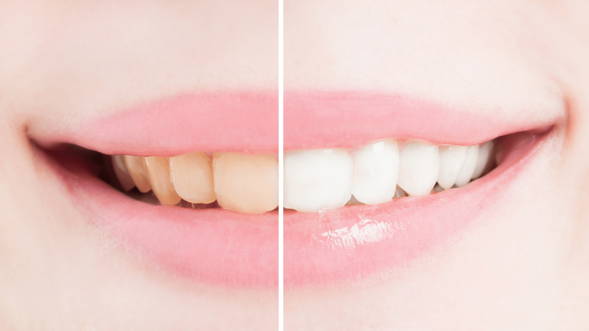 Eclaircissement dentaire