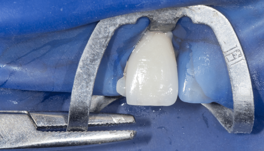 Stabilisation crampon facettes