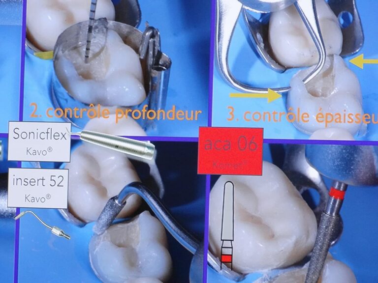 formation dentaire esthétique aix en provence facettes TP travaux pratiques