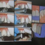 formation dentaire TP travaux pratiques esthétique aix en provence stratification