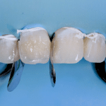 stratification simplifiée antérieures postérieures