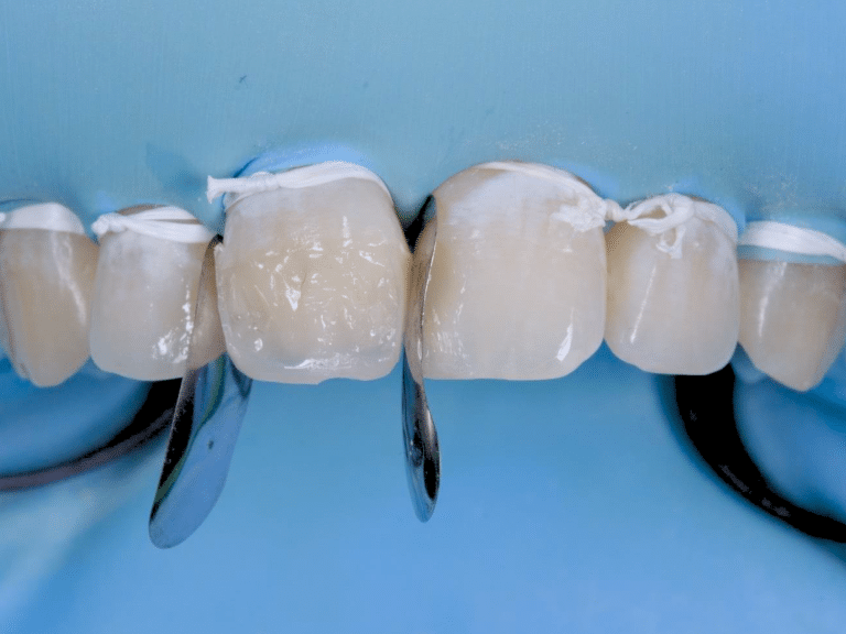 stratification simplifiée antérieures postérieures