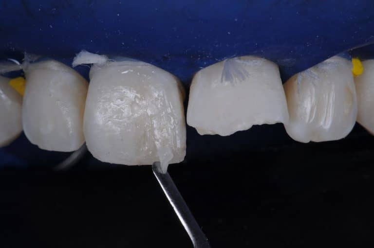 stratification antérieur