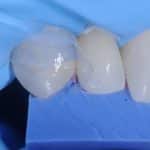 composite dentaire clé