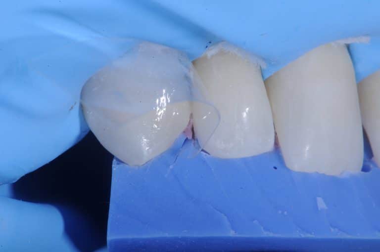 composite dentaire clé