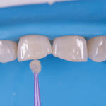 stratification antérieur