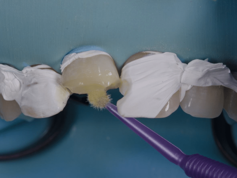 stratification simplifiée antérieures postérieures