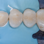 stratification simplifiée antérieures postérieures