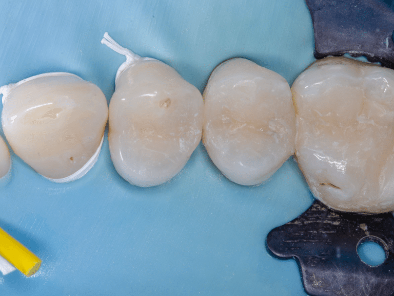 stratification simplifiée antérieures postérieures
