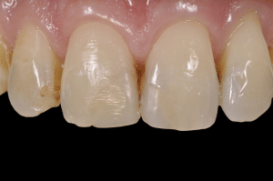 restauration en résine composite avec clef silicone