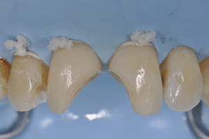 restauration en résine composite avec clef silicone