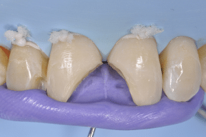 restauration en résine composite avec clés silicone
