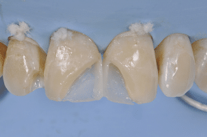 restauration en résine composite avec clef silicone