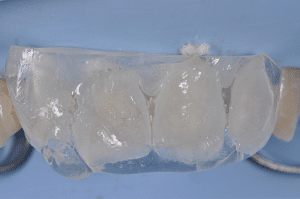 restauration en résine composite avec clés silicone