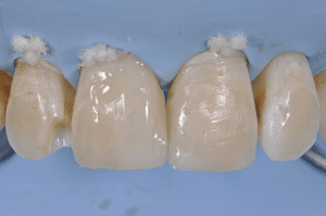 restauration en résine composite avec clef silicone