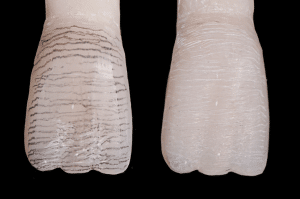 stratification composite