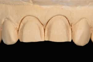 Eliminer point de contact empreinte facette laminaire