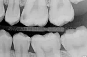 Anneau pour modifier point de contact dentaire