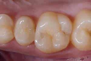 Anneau pour modifier point de contact dentaire