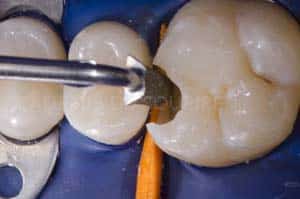 Anneau pour modifier point de contact dentaire