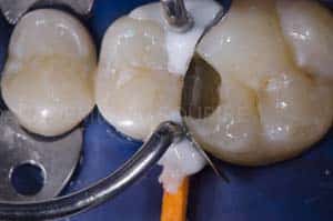 Anneau pour modifier point de contact dentaire