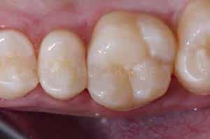 Anneau pour modifier point de contact dentaire
