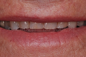 Scellement dent provisoire