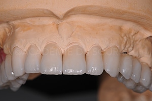 Scellement dent provisoire