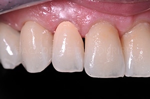 Scellement dent provisoire