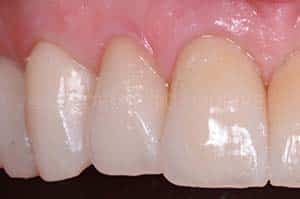 Scellement dent provisoire