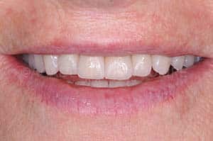 Scellement dent provisoire