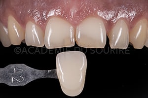 Photo polarisée en dentisterie