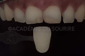 Photo polarisée en dentisterie
