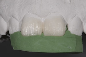 Photo polarisée en dentisterie