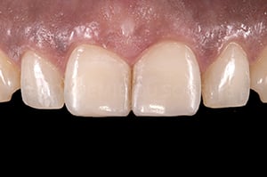 Photo polarisée en dentisterie