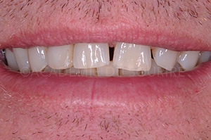 mock up facettes dentaires